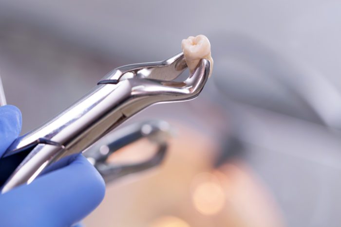 Dental extraction in Franklin, MI