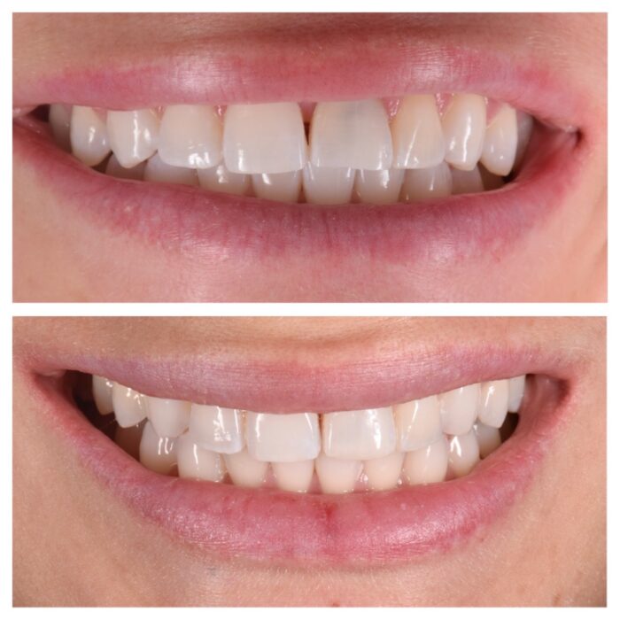 Cosmetic Bonding in Franklin MI