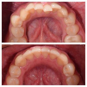 Invisalign orthodontic treatment in Franklin MI