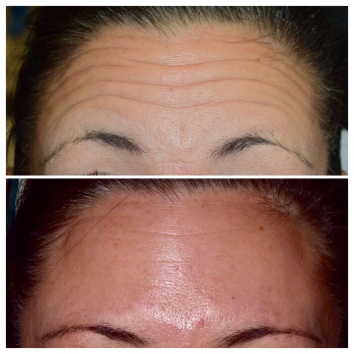 Botox Cosmetic in our Franklin, MI dental office