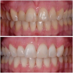 Zoom Teeth Whitening in Franklin, MI
