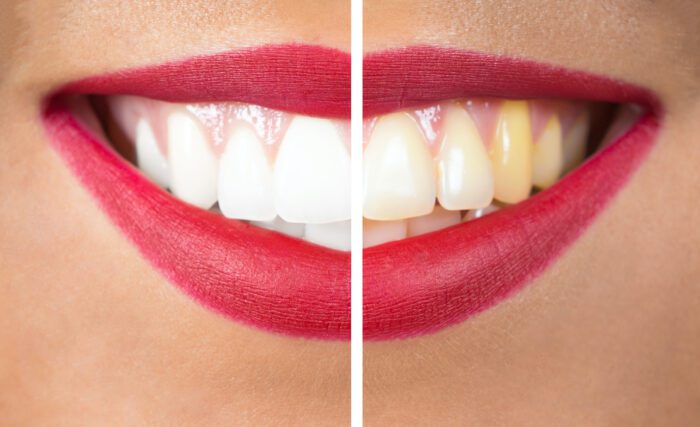 Discolored Teeth in Franklin MI can be caused by many factors, but treatment is available