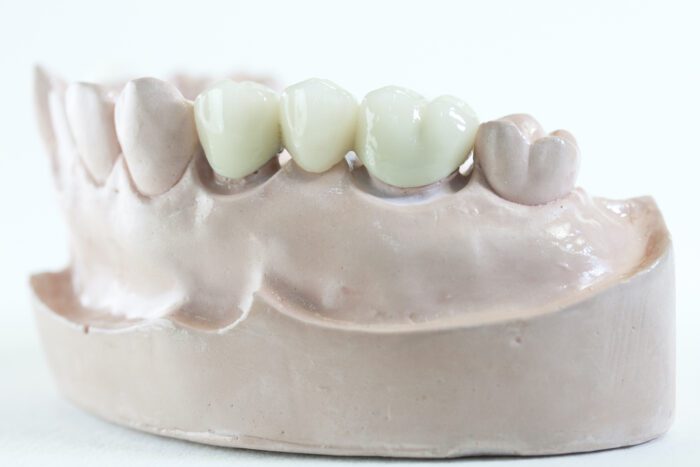 A Dental Bridge in Franklin MI could help restore your bite after tooth loss.