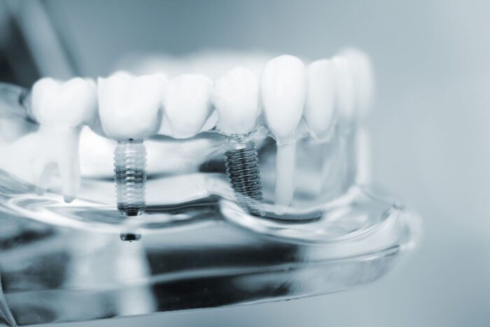 dental implants in Franklin MI need the proper restoration to complete treatment