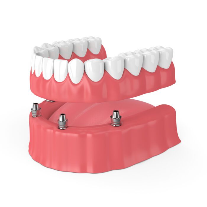 Implant Dentures in Franklin MI