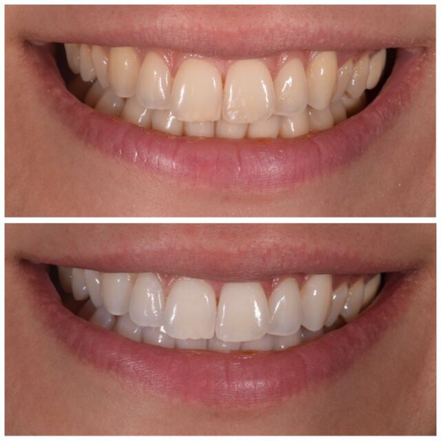 Teeth whitening season is upon us 🌞